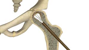 Core Decompression For Avascular Necrosis