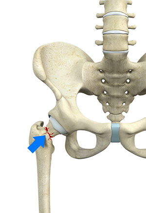 Hip Synovitis