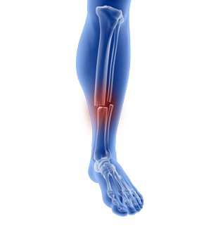 Fractures of the Tibia