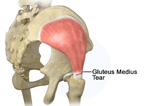 Gluteus medius tear