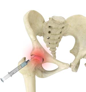 X-ray Guided Hip Injection