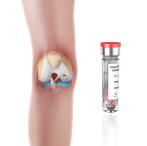 Matrix-induced Chondrocyte Implantation 