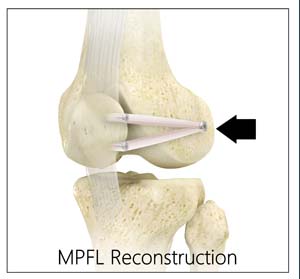 Medial Collateral Ligament Reconstruction 