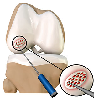 Fractures of the Tibia