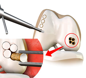 Fractures of the Tibia