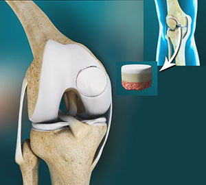 Fractures of the Tibia