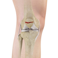 Factures of the Patella