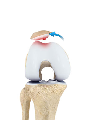 Fractures of the Tibia