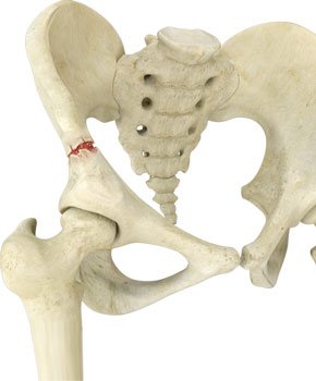 Pelvis Fracture 