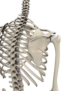 Scapula Fracture